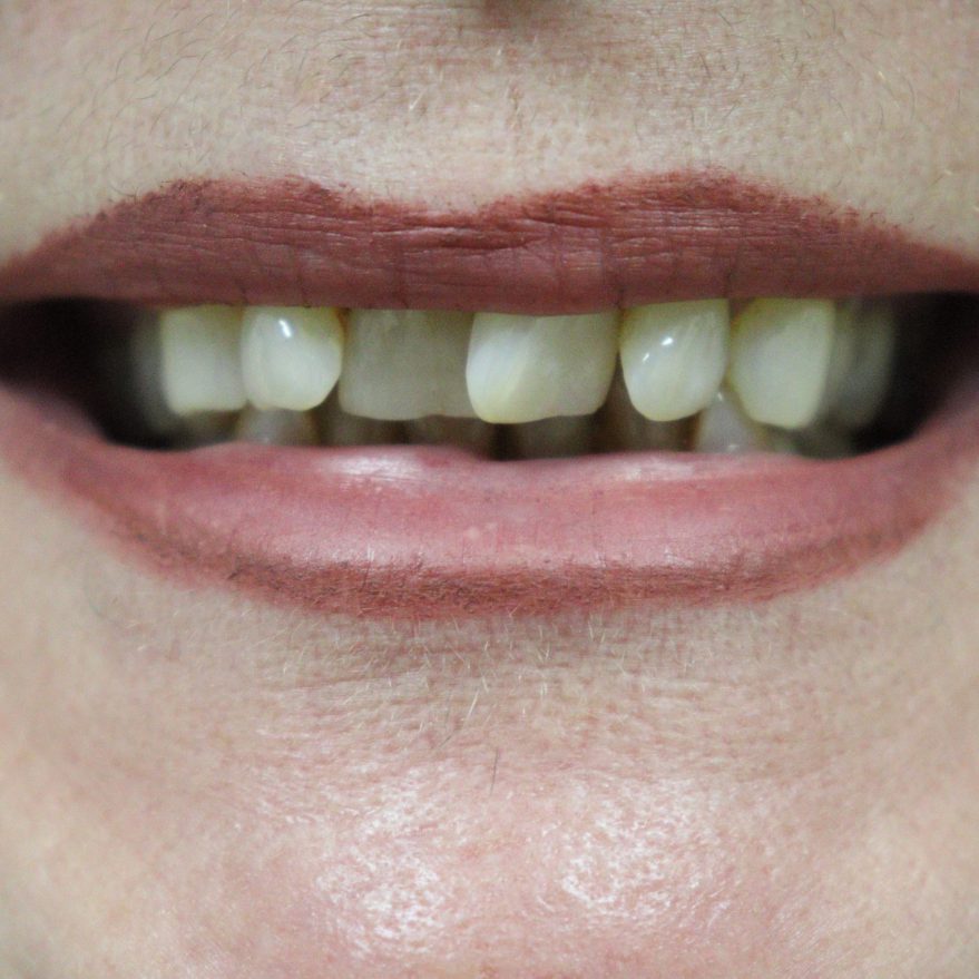 VieDenta Kliniek facings voorfoto