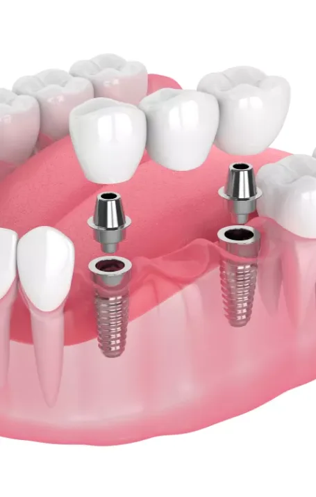 VieDenta Kliniek brug op implantaten