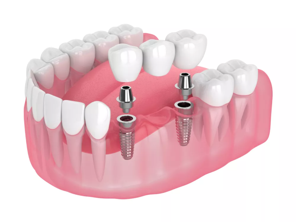 Brug op implantaten