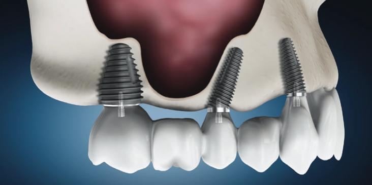 Southern Implants